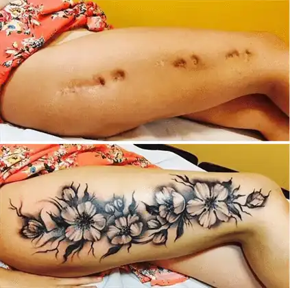 Scar Cover-Up Tattoos in Madrid