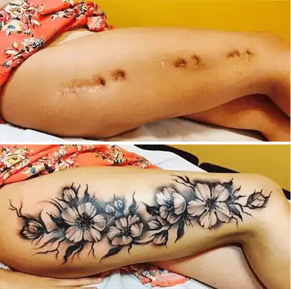 Tatuajes Para Cubrir Cicatrices en Madrid